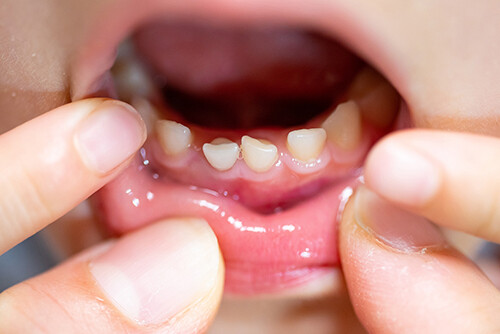 乳歯のむし歯を放置