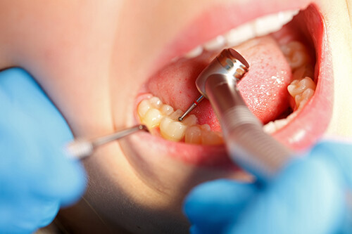 歯質の保存